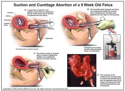 Abortionmethods