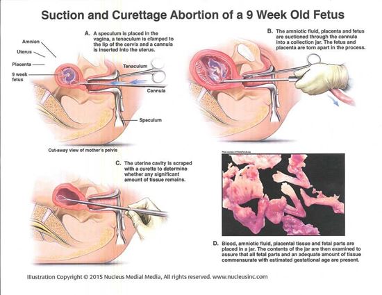 Suction-and-curettage-abortion-diagram