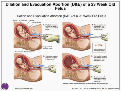 Dilation & Evacuation Abortion (1)